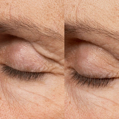 Summer Six Glass Skin Duo: Anti-Wrinkle Injections 2/3 Areas + Choice of Skin Booster