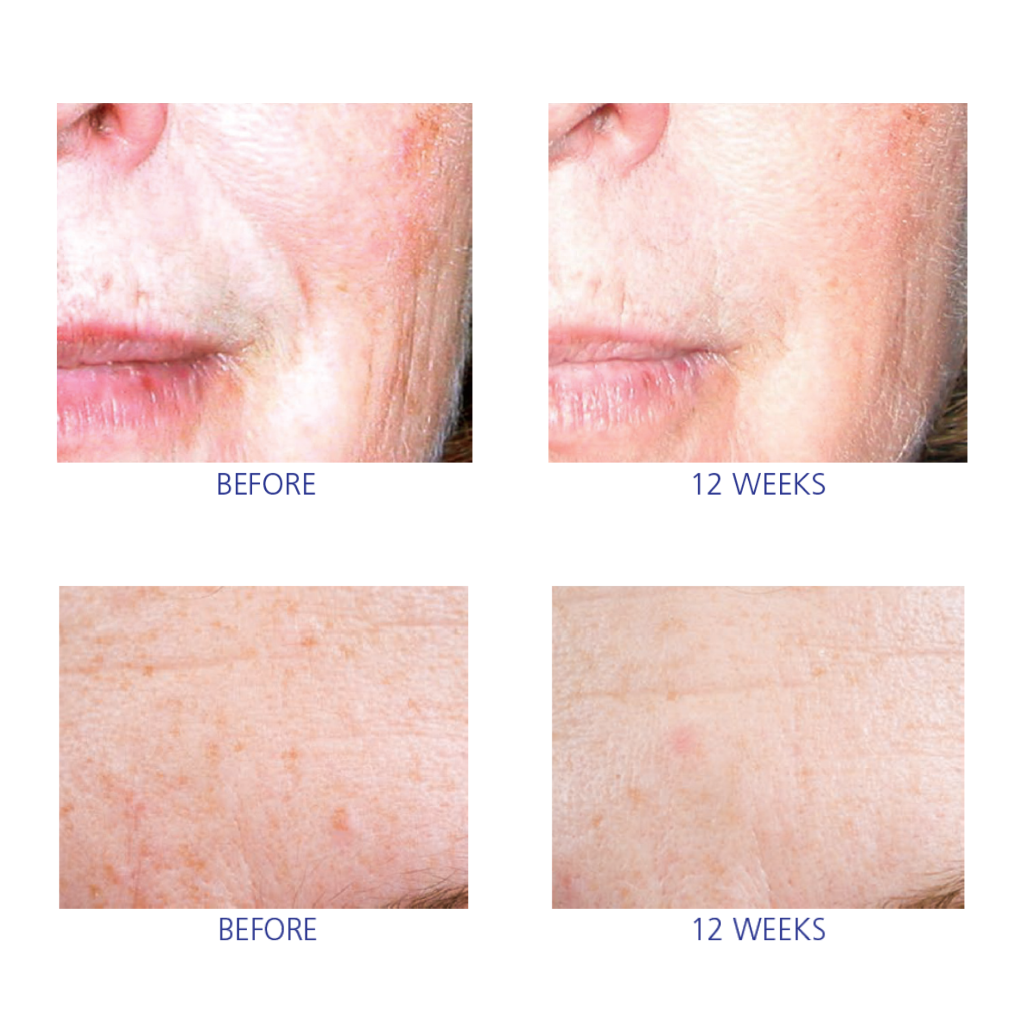 iS Clinical Active Serum