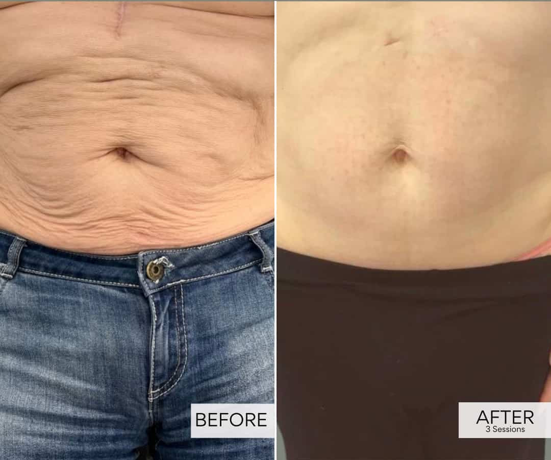 Morpheus8 Deep RF Microneedling for Body Area course of 3 (save up to €2251)