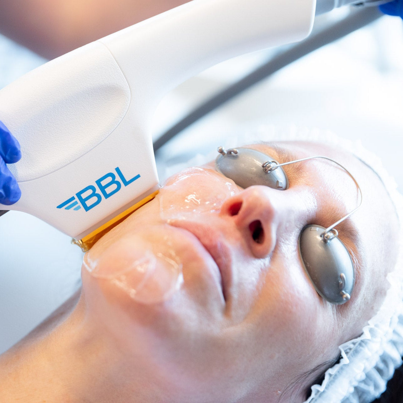 Summer Stax Laser Duo: BBL + MOXI Skin Rejuvenation (save up to €551)