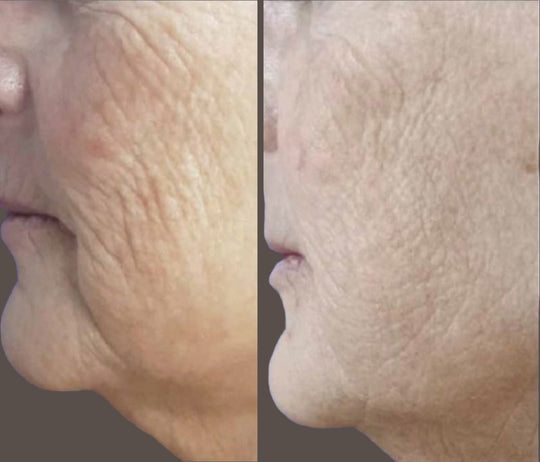 Purasomes Exosome Treatment for Face or Scalp (save €101)