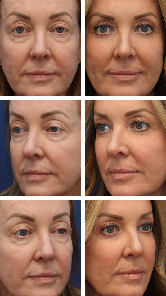 Ultimate Eye Duo: Secret Pro CO2 laser for eyes +Polynucleotides (save up to €1,001)