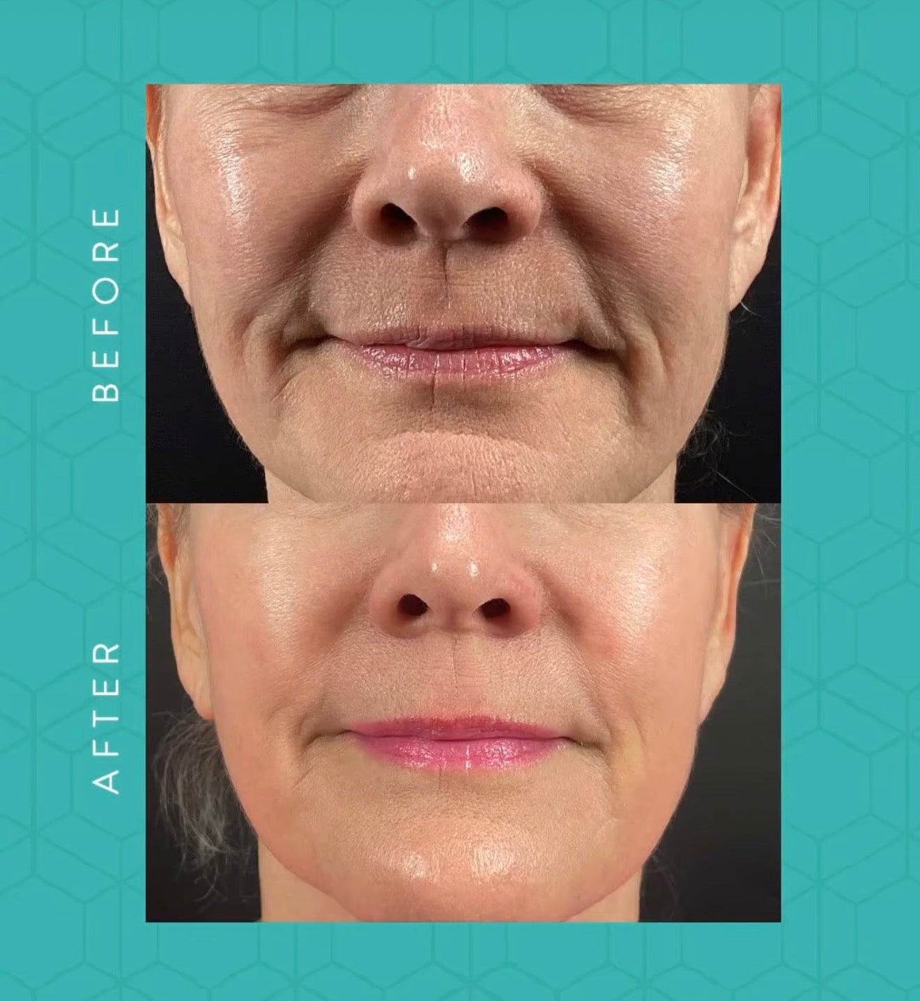 Morpheus8 Burst RF Microneedling with optional Exosomes (save up to €1,301)