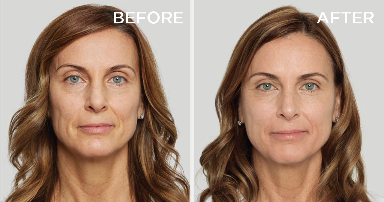 Sculptra Plump & Refresh Bio Stimulator Collagen Treatment (save €201)