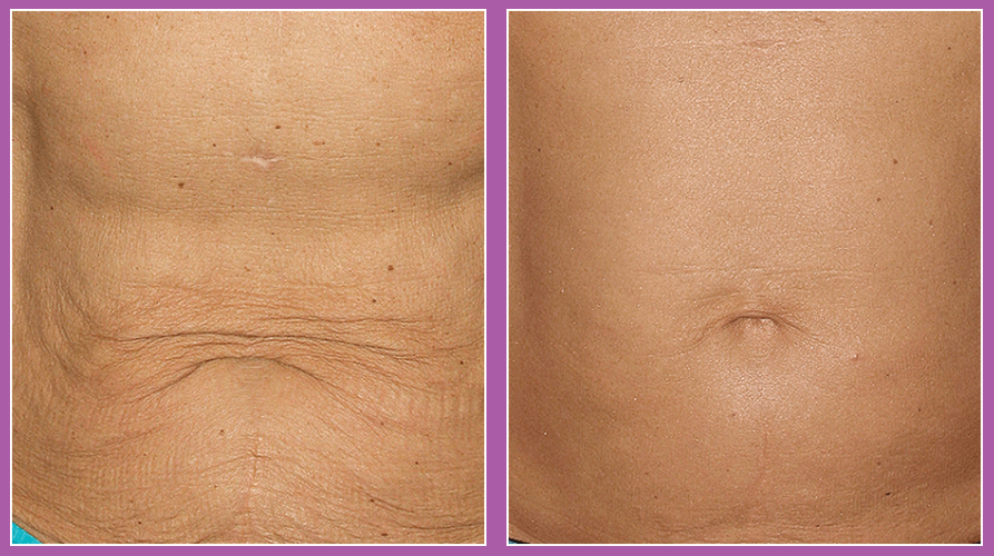 Thermage FLX RF Anti-Ageing Skin Tightening Treatment (save up to €601)