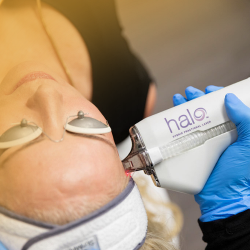 Summer Stax Laser Duo: BBL + HALO Skin Rejuvenation (save up to €601)