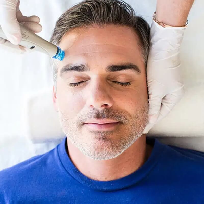 Summer Six Collagen Reset: HydraFacial + Microneedling + Exosomes (save up to €401)