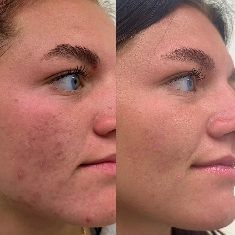 Cutera Secret RF Microneedling (save up to €601)