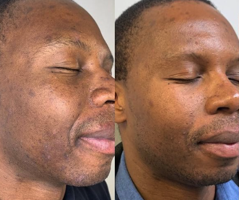MOXI Laser Skin Rejuvenation Single Session (save €101)