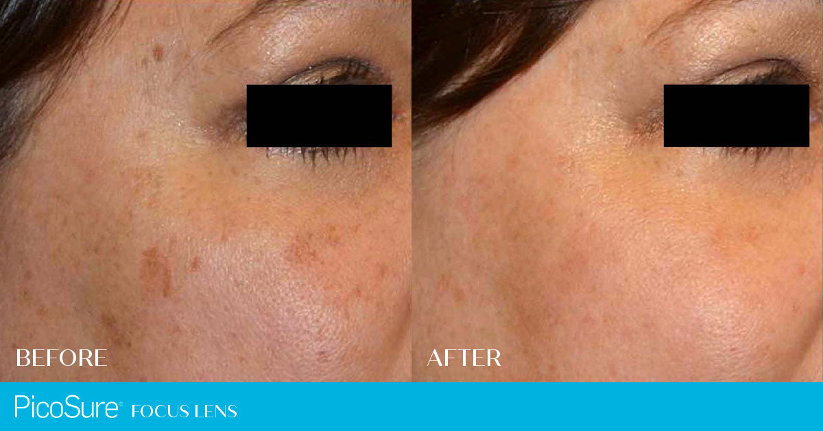 PicoSure Laser Skin Rejuvenation for Pigmentation & Melasma Course of 3 (save up to €701)