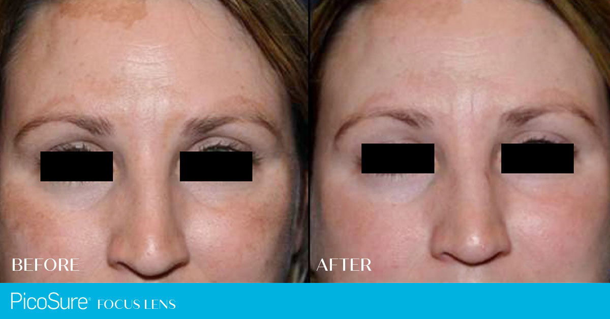PicoSure Laser Skin Rejuvenation for Pigmentation & Melasma Course of 3 (save up to €701)