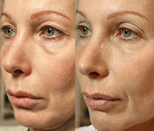 Thermage RF Anti-Ageing Skin Tightening Treatment (save €251)
