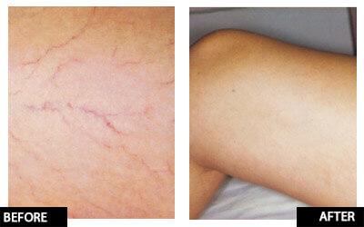 Laser thread vein reduction for medium or large area (save up to €601)