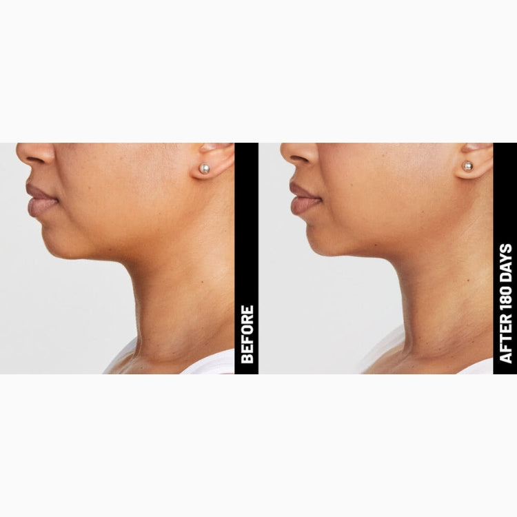 Ultherapy Prime Non-Surgical Face Lift & Skin Tightening (save €851)