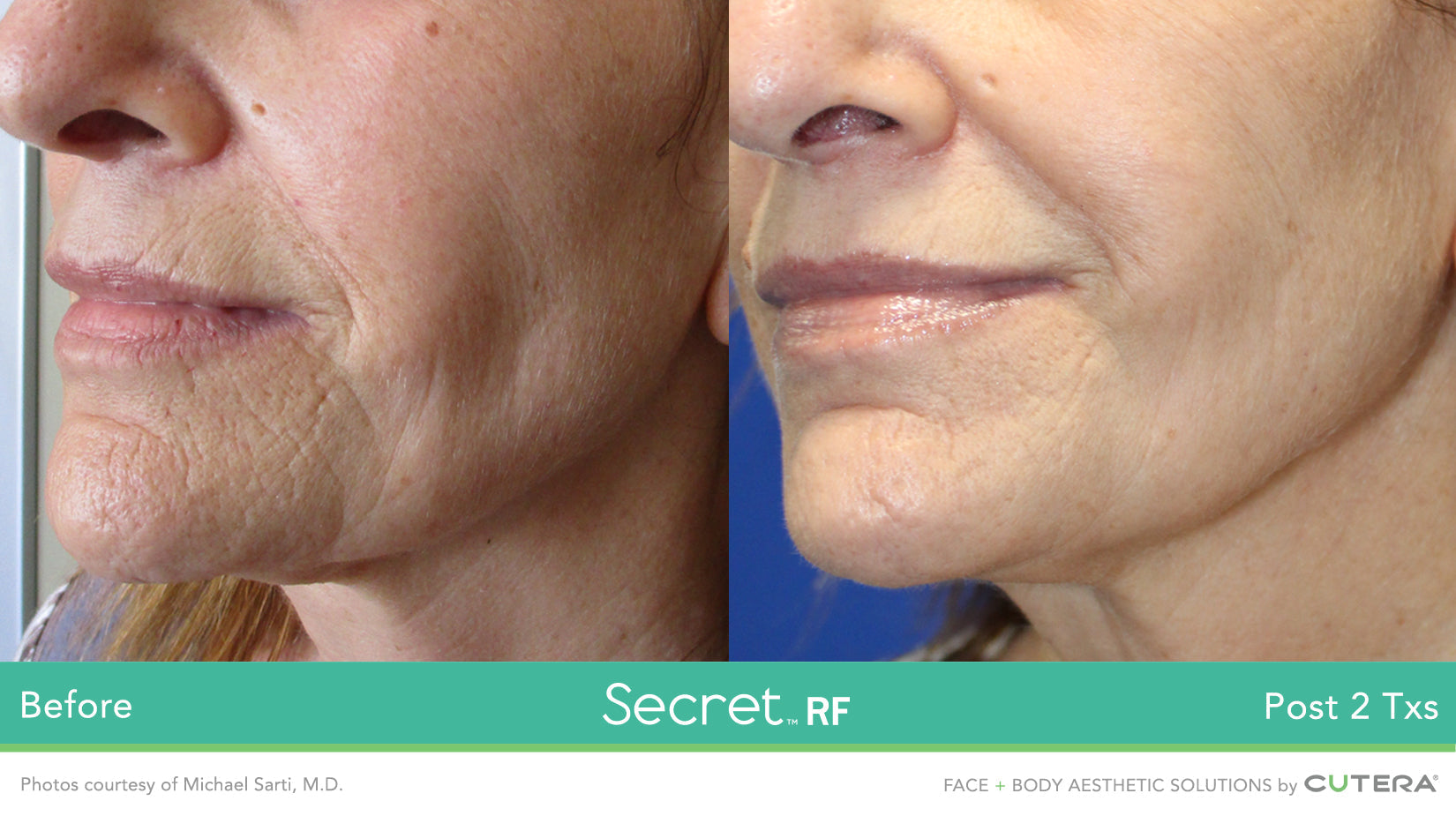 Cutera Secret RF +Microneedling with complimentary choice of skin booster (save €351)