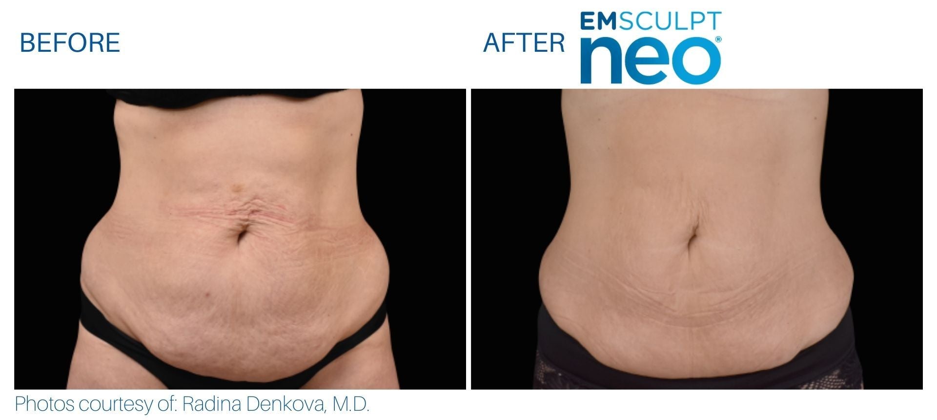 EmSculpt NEO Muscle Building & Fat Burning course of 5 (save €751)