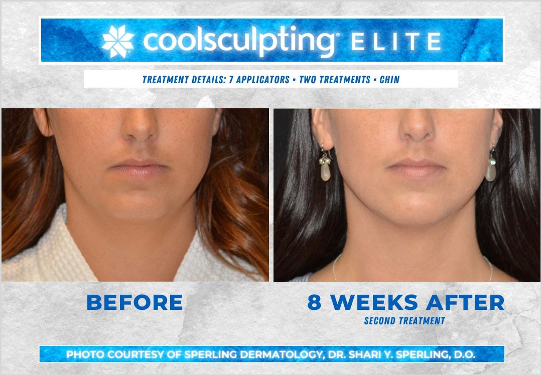 CoolSculpting Elite Chin Fat Package with RF Microneedling (save €1,151)
