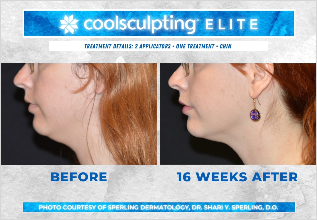 CoolSculpting Elite Chin Fat Package with RF Microneedling (save €1,151)