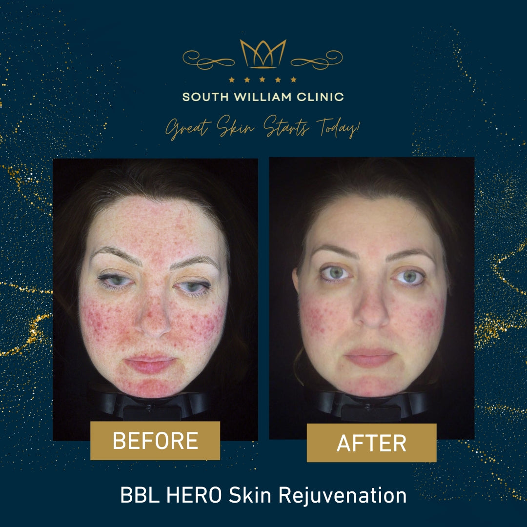 BBL HERO Photofacial Skin Rejuvenation save up to €701