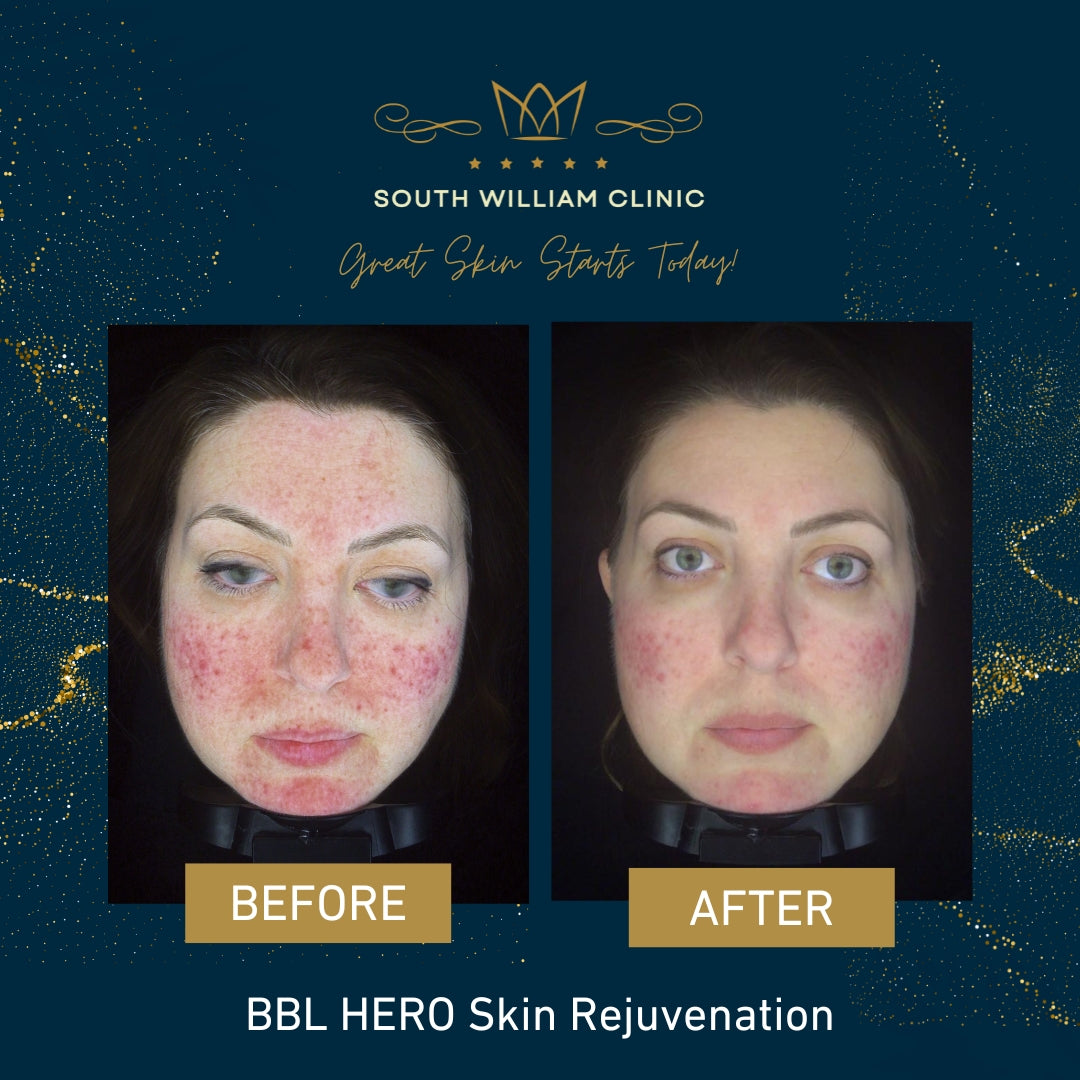 BBL Laser Skin Rejuvenation Course of 3 (save up to €301)