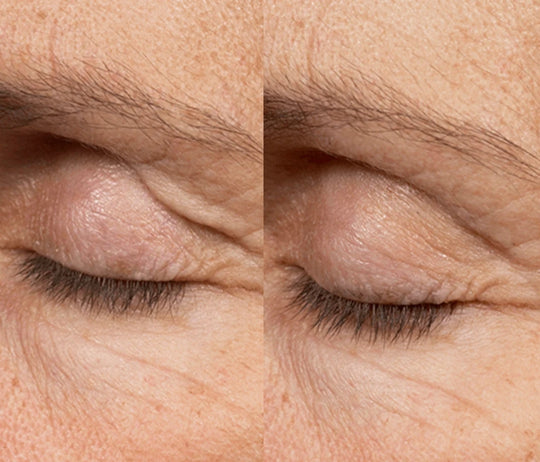 Summer Six Glass Skin Duo: Anti-Wrinkle Injections 2/3 Areas + Choice of Skin Booster