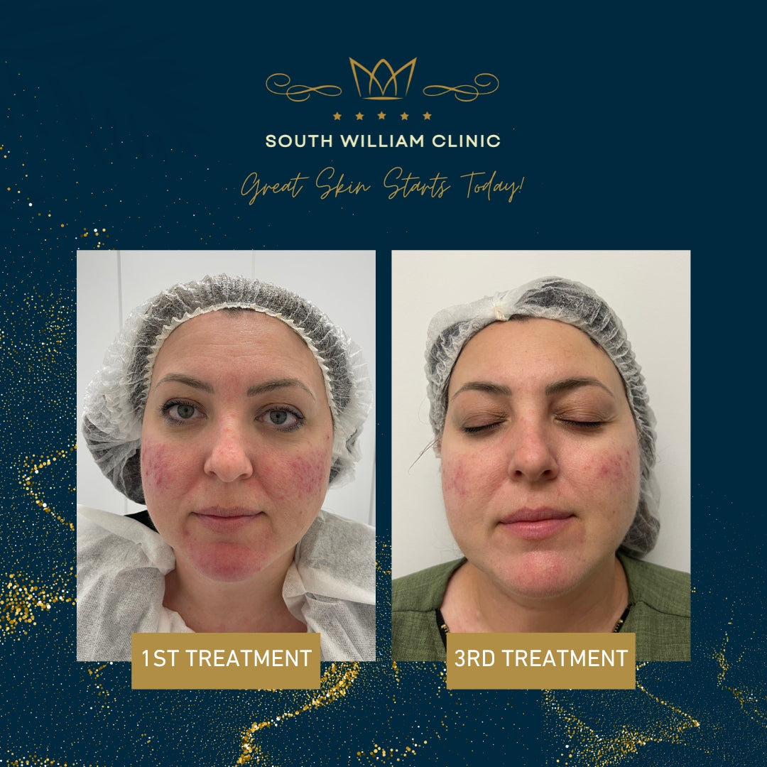 BBL Laser Skin Rejuvenation Course of 3 (save up to €301)