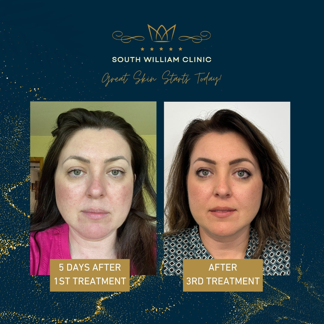 BBL Laser Skin Rejuvenation Course of 3 (save up to €301)