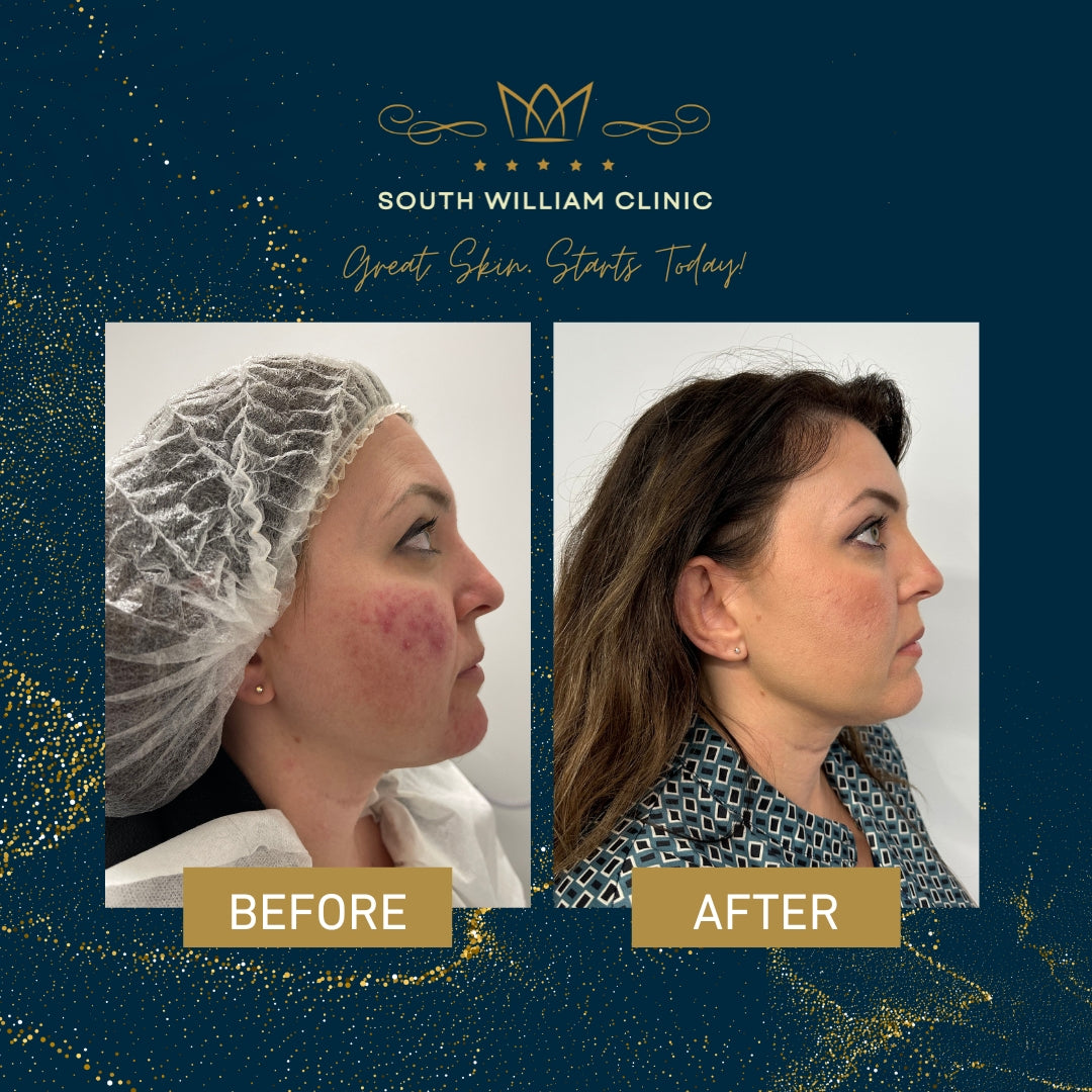 BBL Laser Skin Rejuvenation Course of 3 (save up to €301)