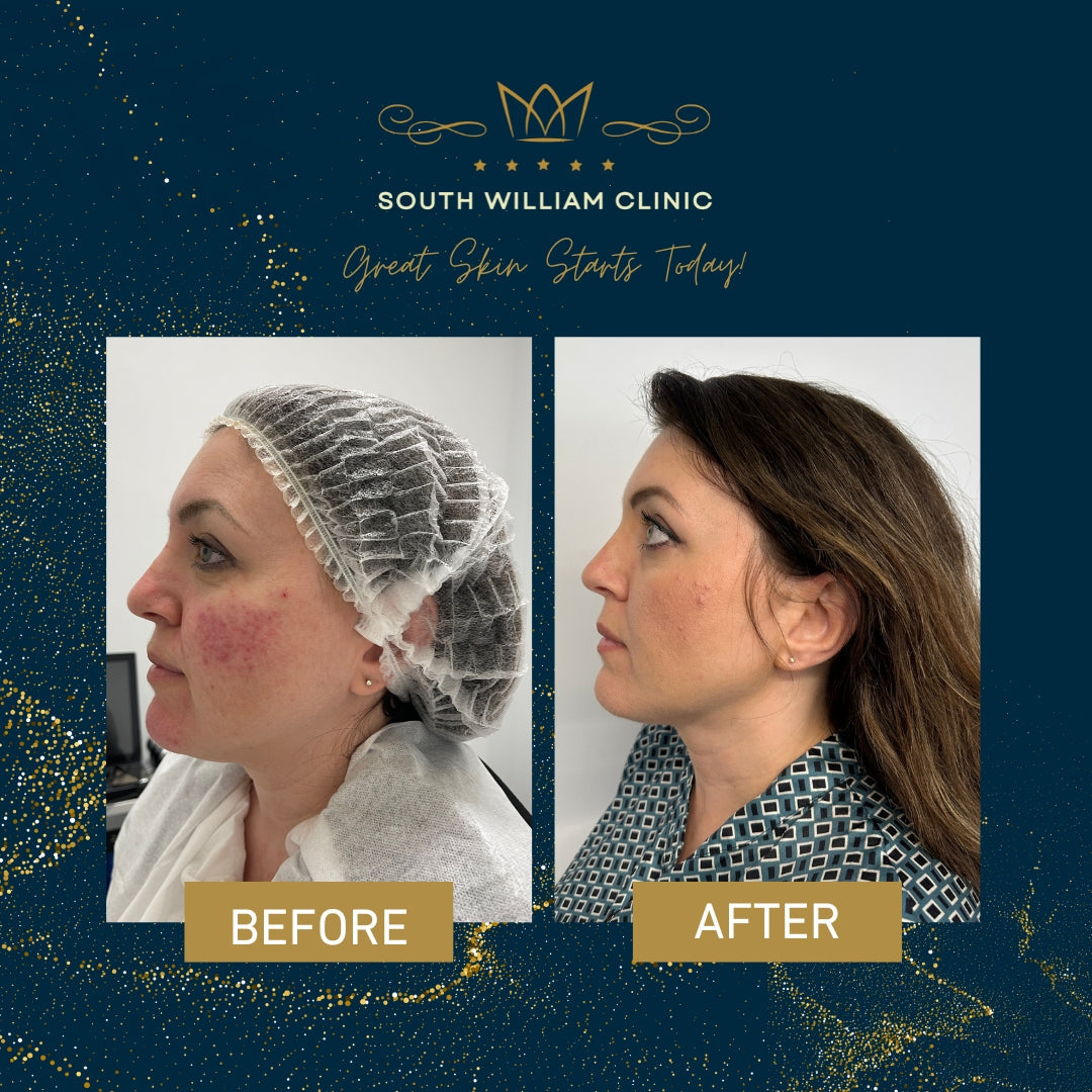 BBL Laser Skin Rejuvenation Course of 3 (save up to €301)