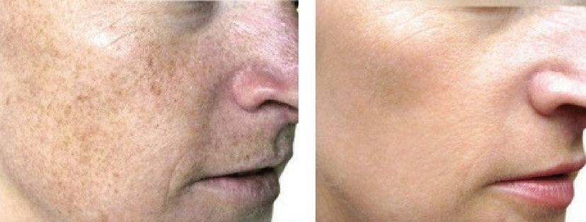 BBL HERO Laser Skin Rejuvenation Course of 2 (Save €301)