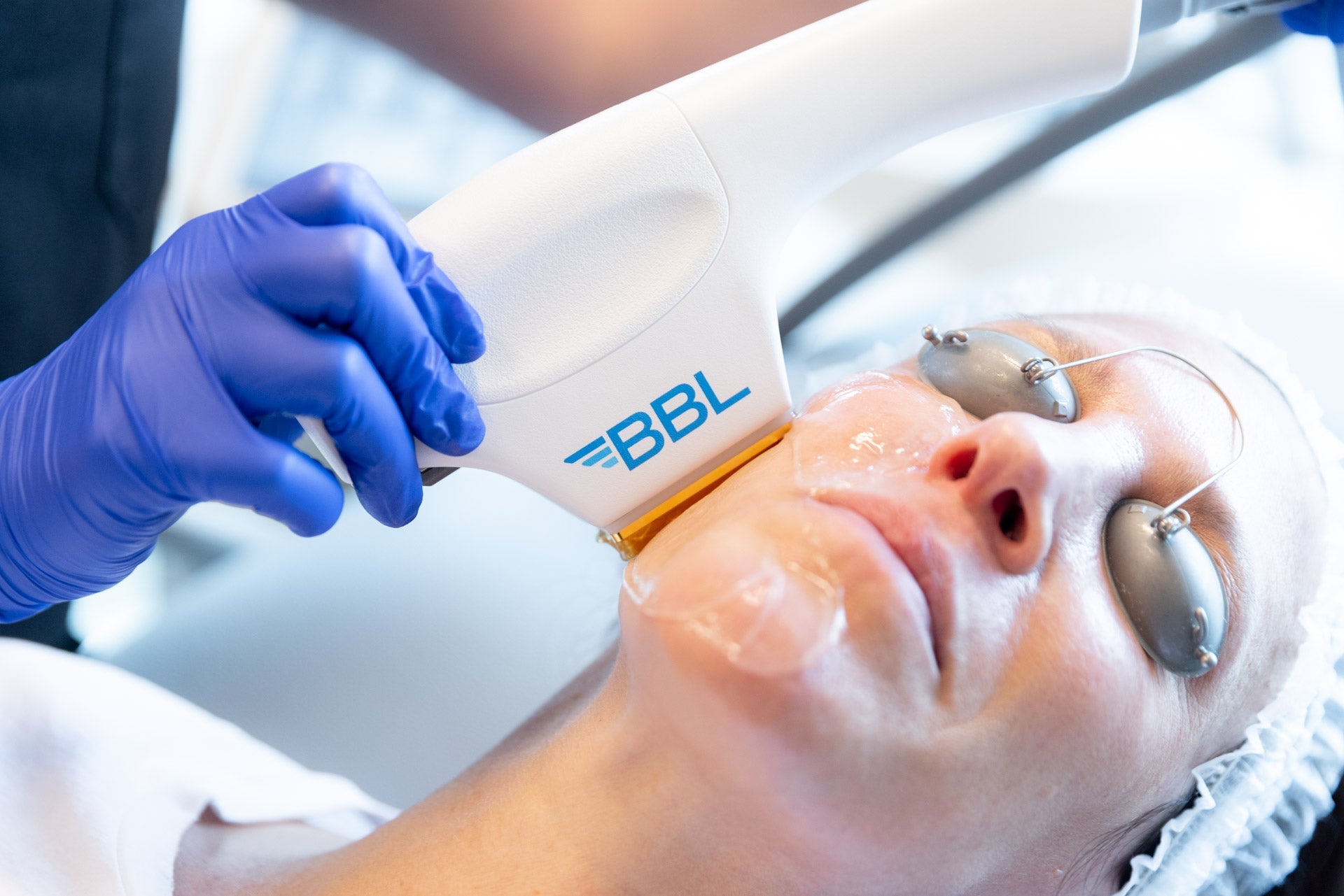 Gold Skin Rejuvenation Package: BBL + Microneedling for Face & Neck Course of 3 (save €400)