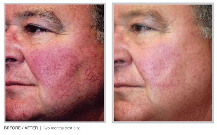 BBL HERO Laser Skin Rejuvenation Course of 2 (Save €301)