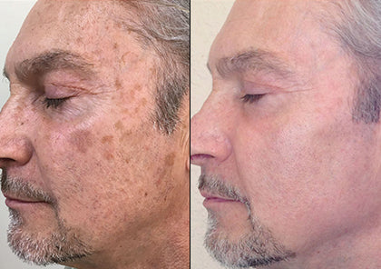 HALO Laser Skin Resurfacing Package for Face & Neck (save €401)