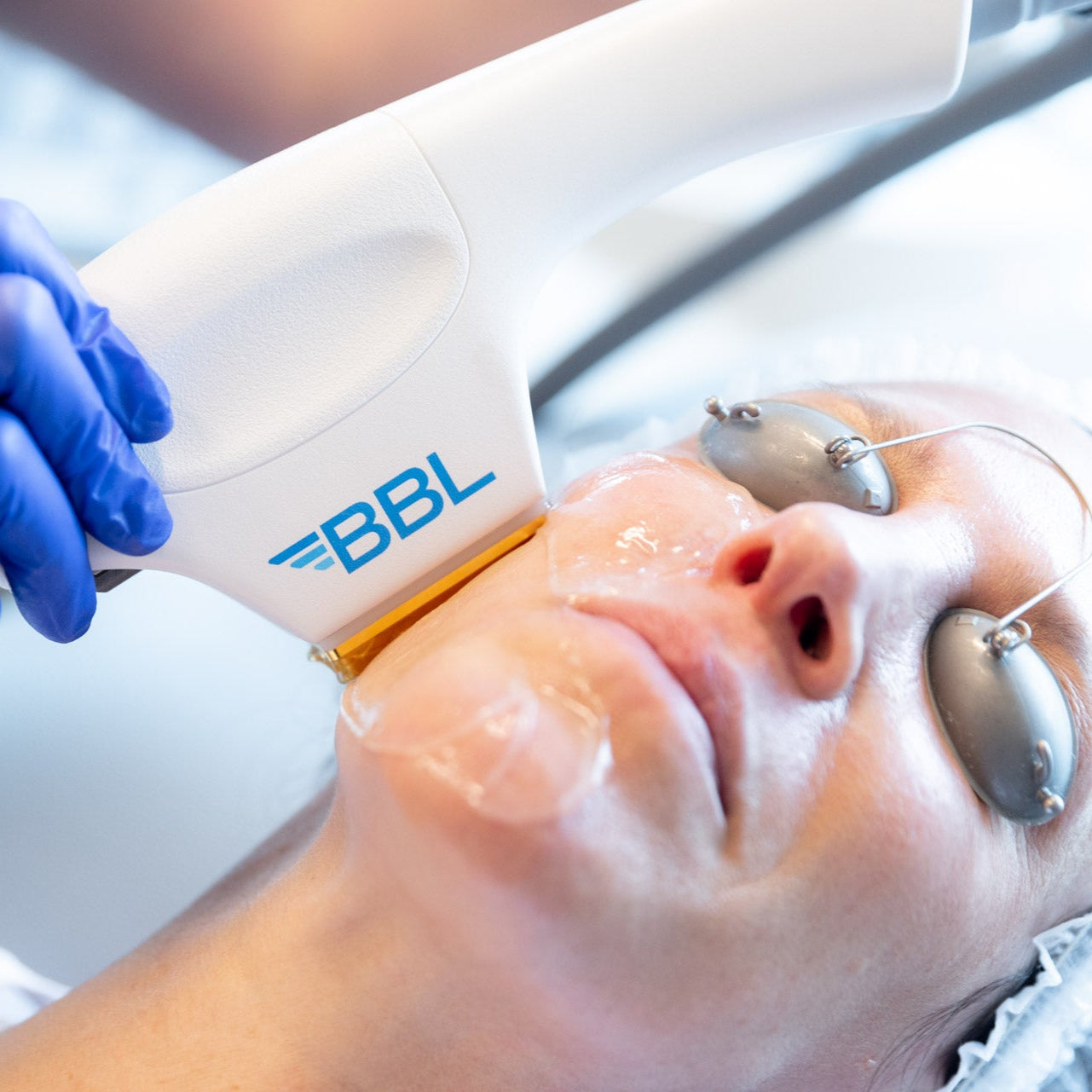 Signature 5-Step Advanced Facial: HydraFacial, BBL Laser, Microneedling, Uber Peel, & LED