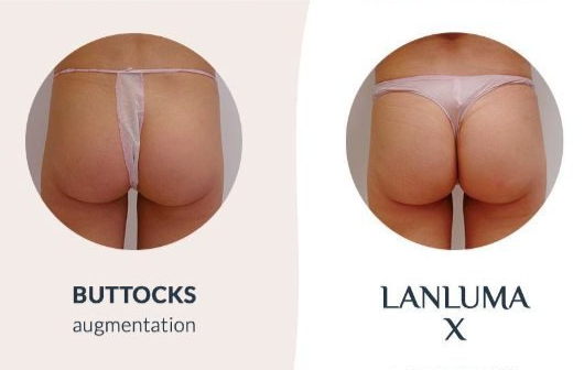 Lanluma Bum Transformation Package (save €351)