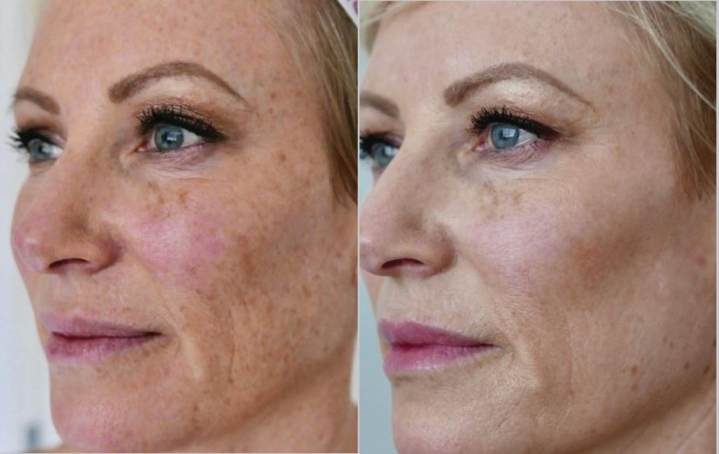 HALO Laser Skin Resurfacing Package for Face & Neck (save €401)