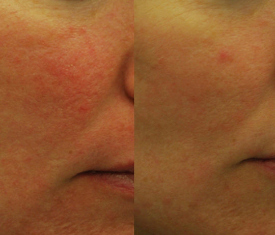 Morpheus8 before after 1.jpg__PID:702d2092-3c32-47ed-81c7-c49ac0bfdb51