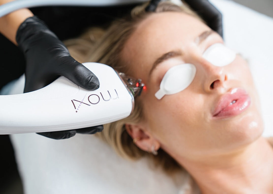 NEW MOXI Laser Skin Rejuvenation save up to €901