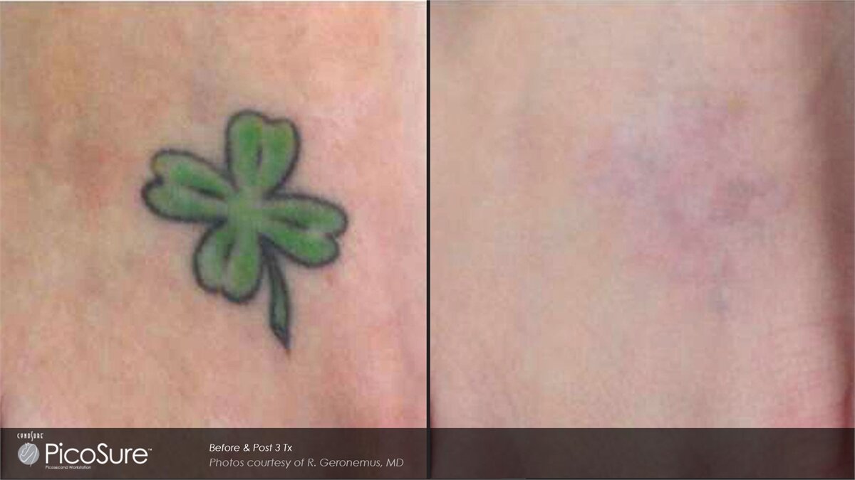 Picosure Laser Tattoo Removal Single Session