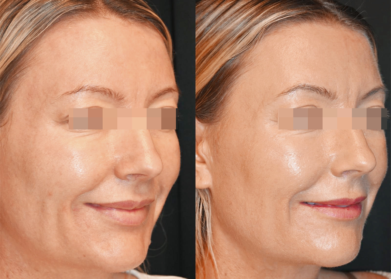 Juläine of Sweden Biostimulators Course of 3 (save €501)
