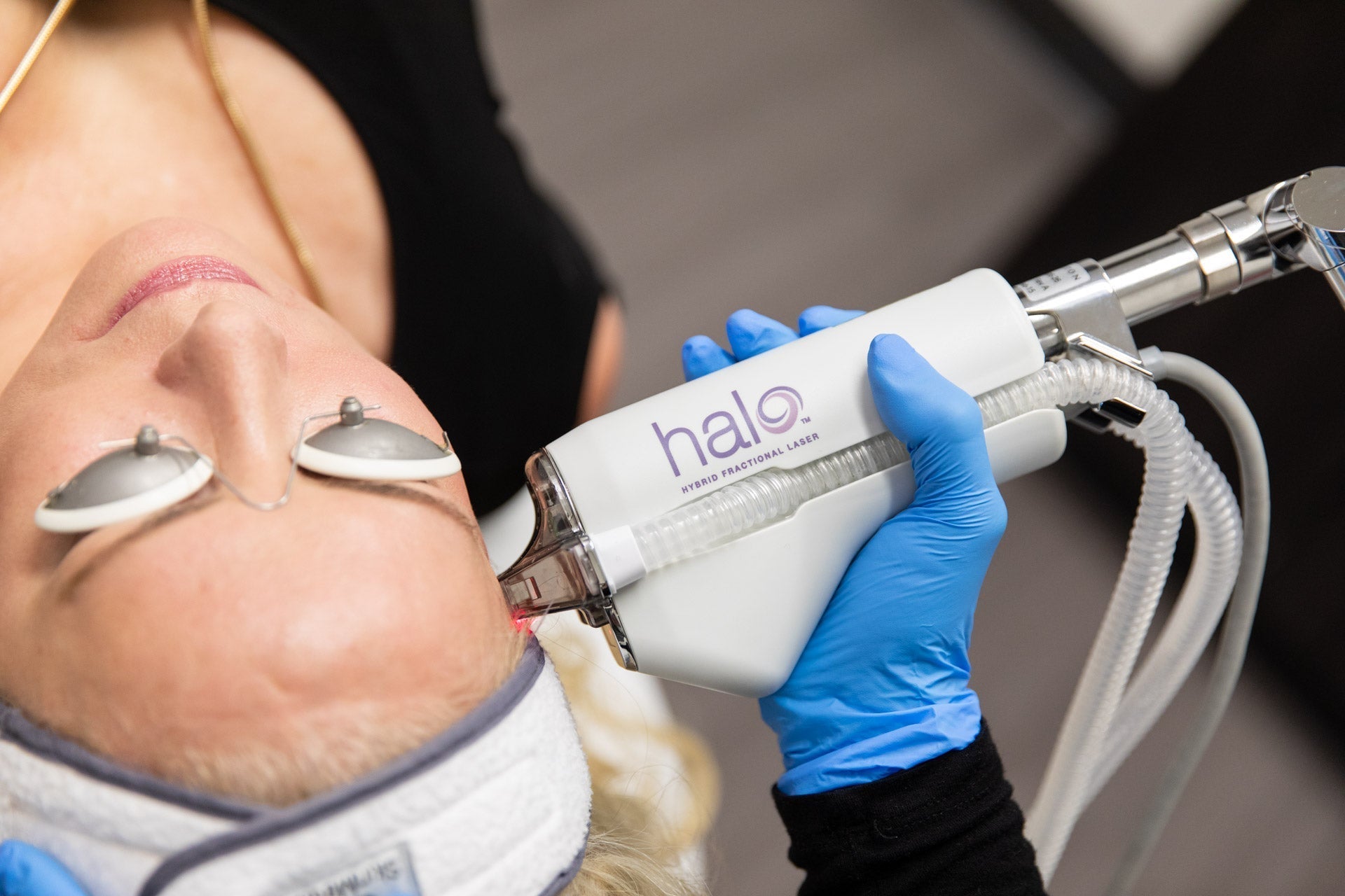 HALO Laser Skin Resurfacing Package for Face & Neck (save €401)