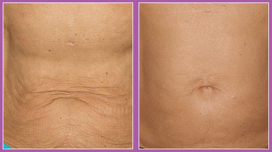 Thermage FLX RF Anti-Ageing Skin Tightening Treatment (save up to €501)