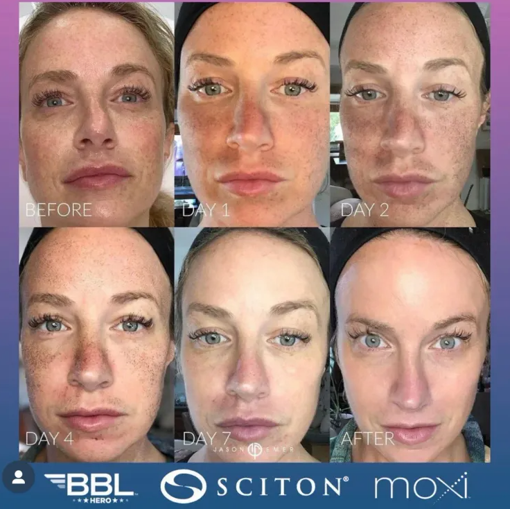 Summer Stax Laser Duo: BBL + MOXI Skin Rejuvenation (save up to €551)