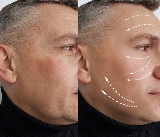 Anti-Wrinkle 2/3 Areas (save up to €221)