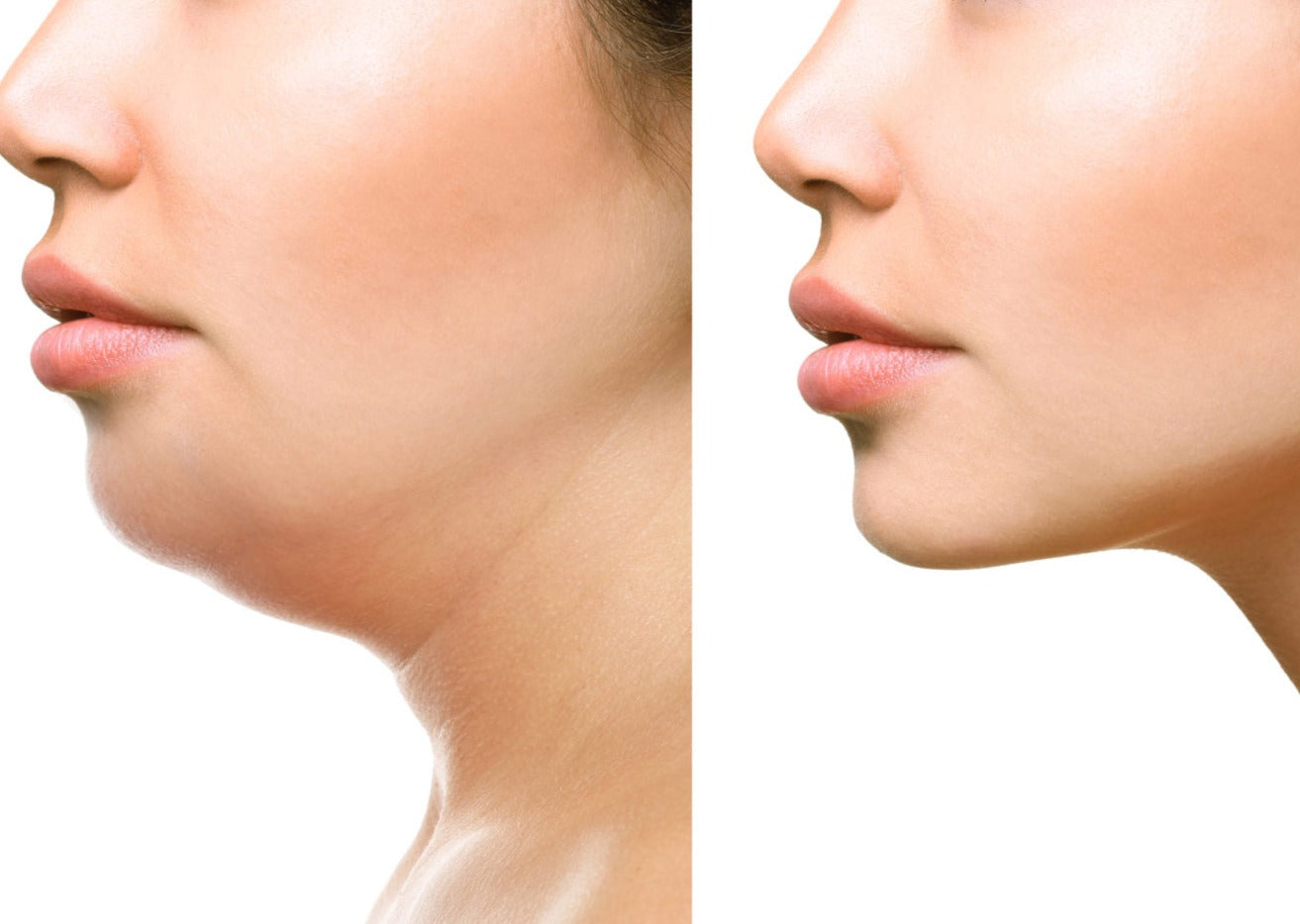 CoolSculpting Elite Chin Fat Package with RF Microneedling (save €1,151)