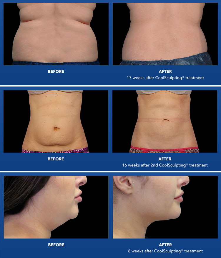 CoolSculpting Elite Chin Fat Package with RF Microneedling (save €1,151)