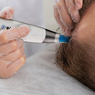 Microneedling with Exosomes Ultimate Scalp Package with Homecare Kit (save €356)