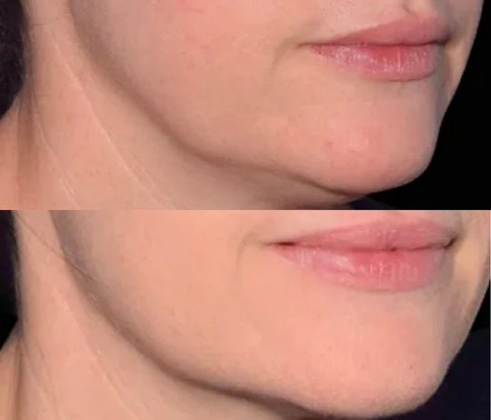 EmFace Non-Invasive Wrinkle and Lifting Treatment (save €201)