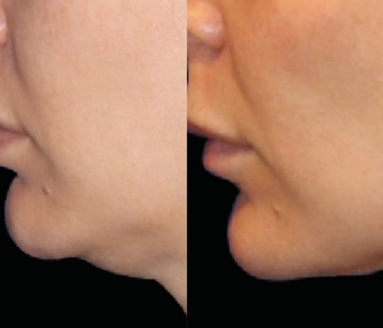 EmFace Non-Invasive Wrinkle and Lifting Treatment (save €201)