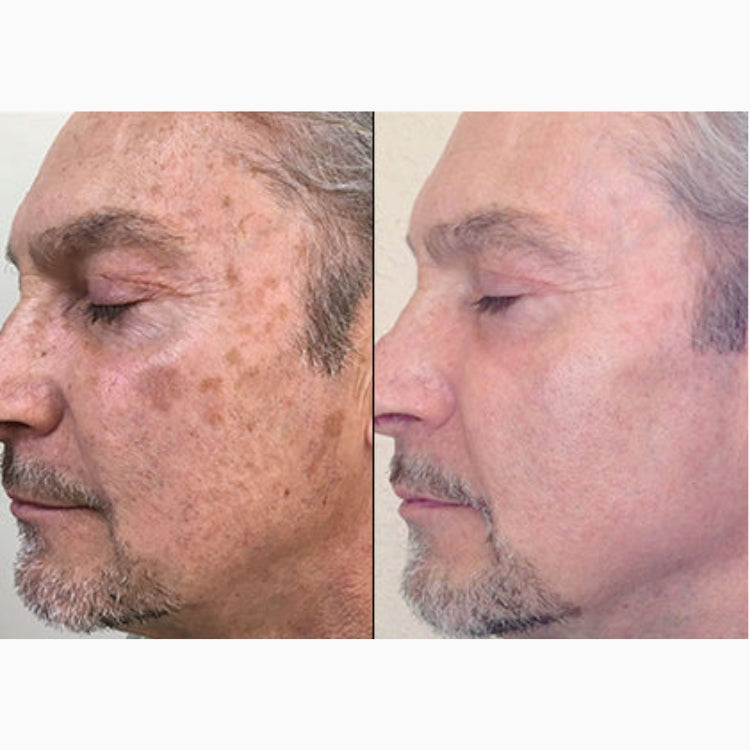 HALO Laser Skin Resurfacing Course of 2 (save up to €801)